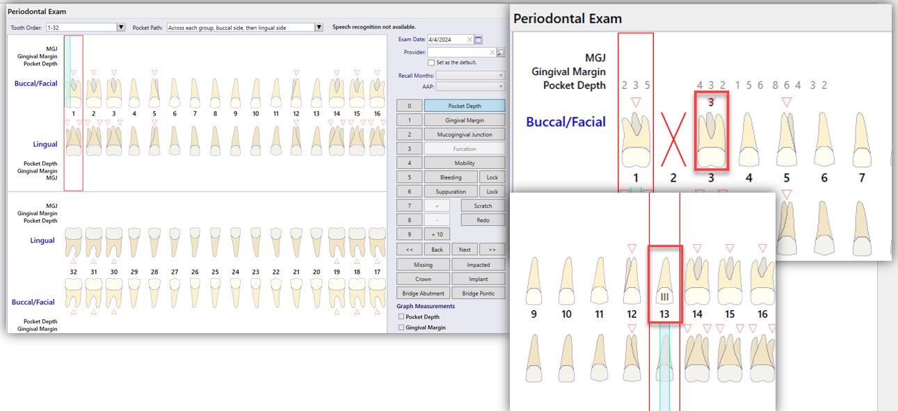 nextgen-edr-periodontal-charting-furcation-updates-osis